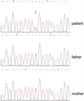 Case report: A STAT1 gain-of-function mutation causes a syndrome of combined immunodeficiency, autoimmunity and pure red cell aplasia